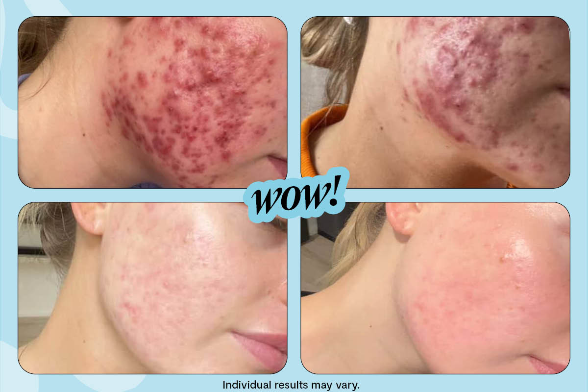 Isabella's Acne-Busting Natural Skincare Routine